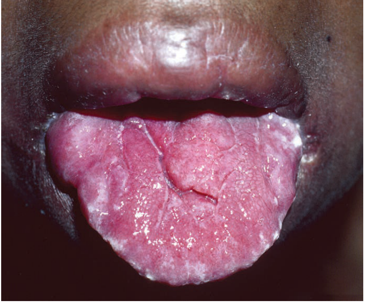 Melkersson-Rosenthal syndrome - scrotal tongue