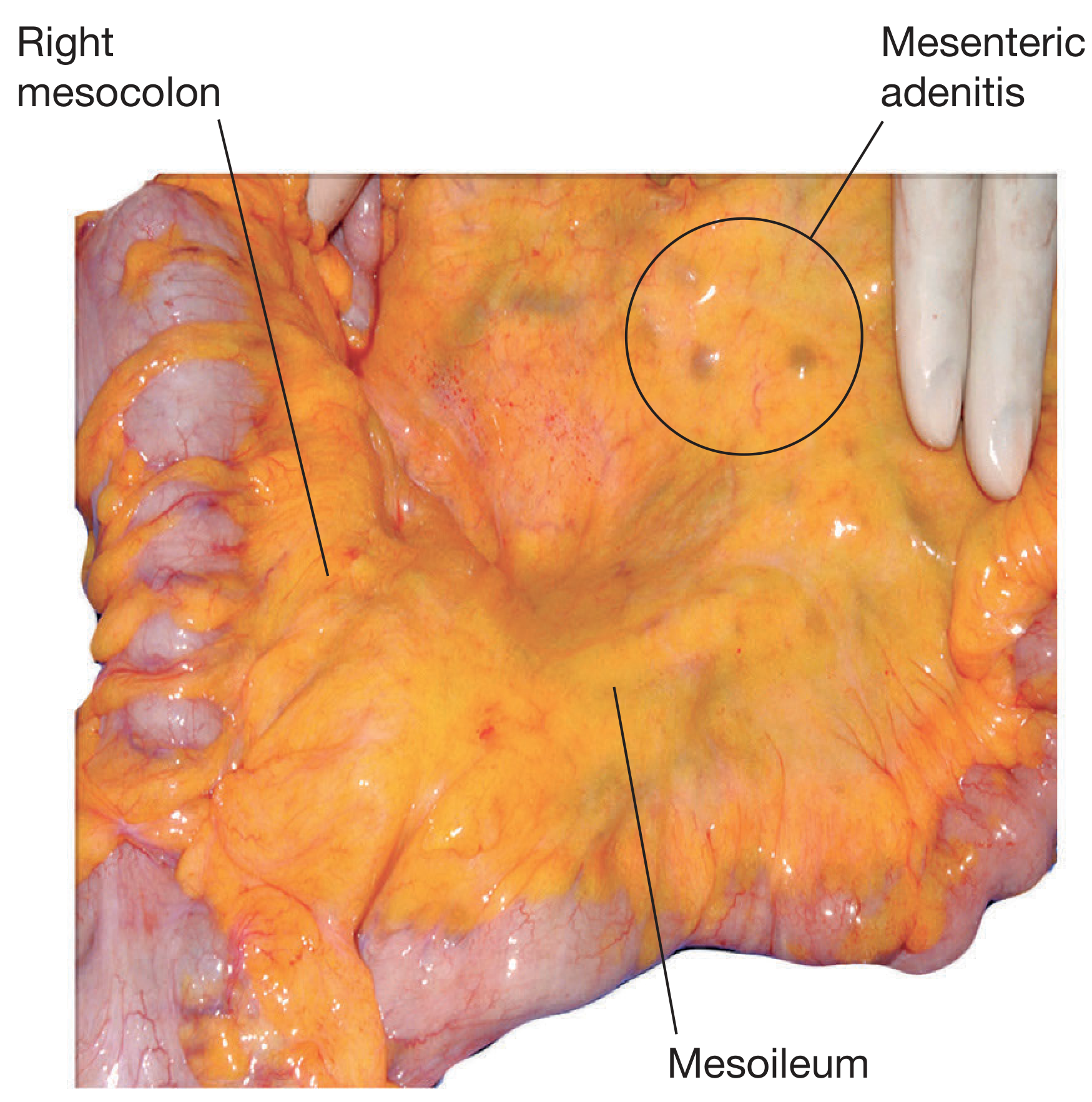 Mesenteric adenitis showing enlarged lymph nodes in the ileocaecal mesentery