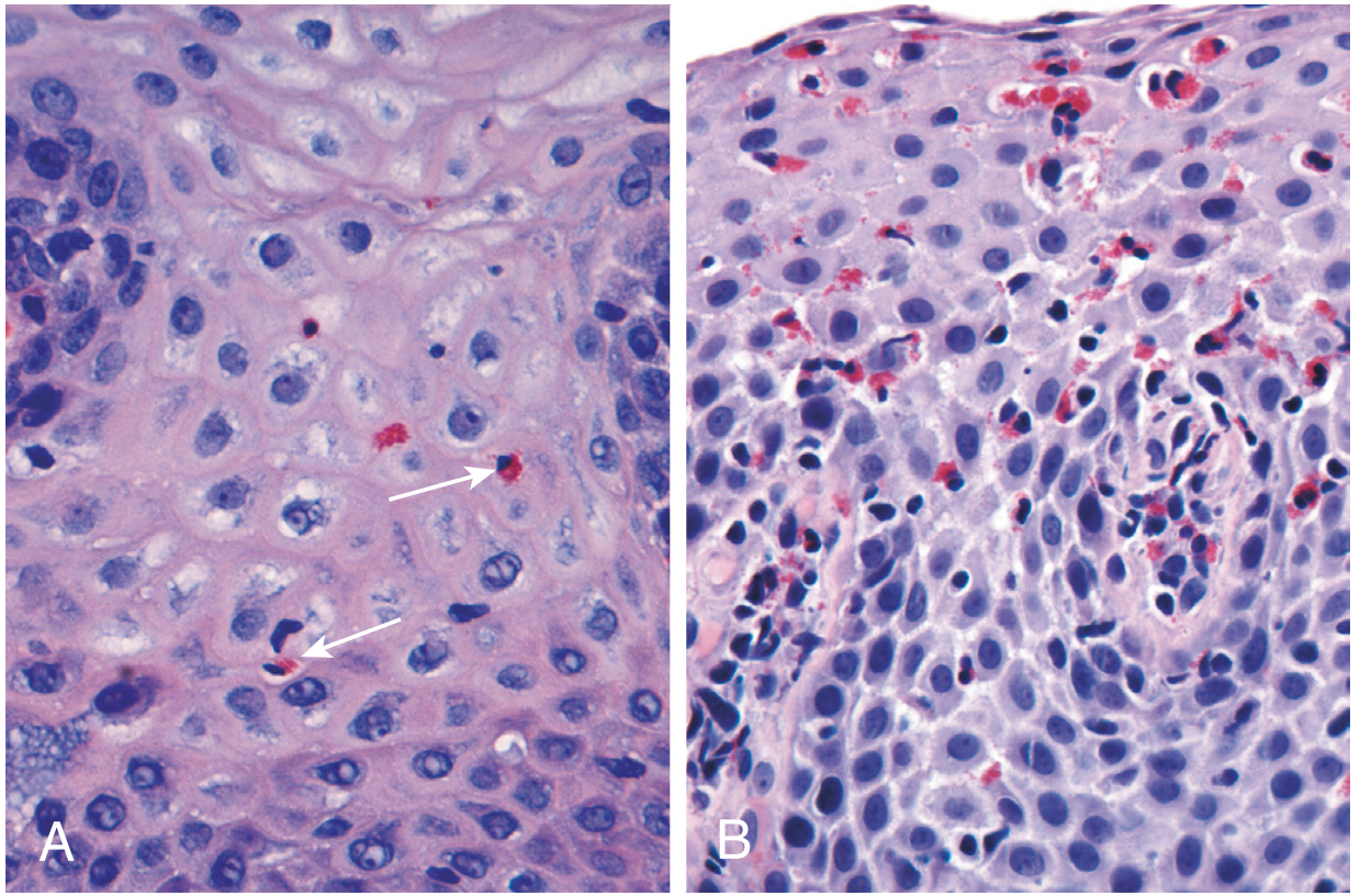 Eosinophilic esophagitis histology showing dense eosinophilic infiltrate vs. normal