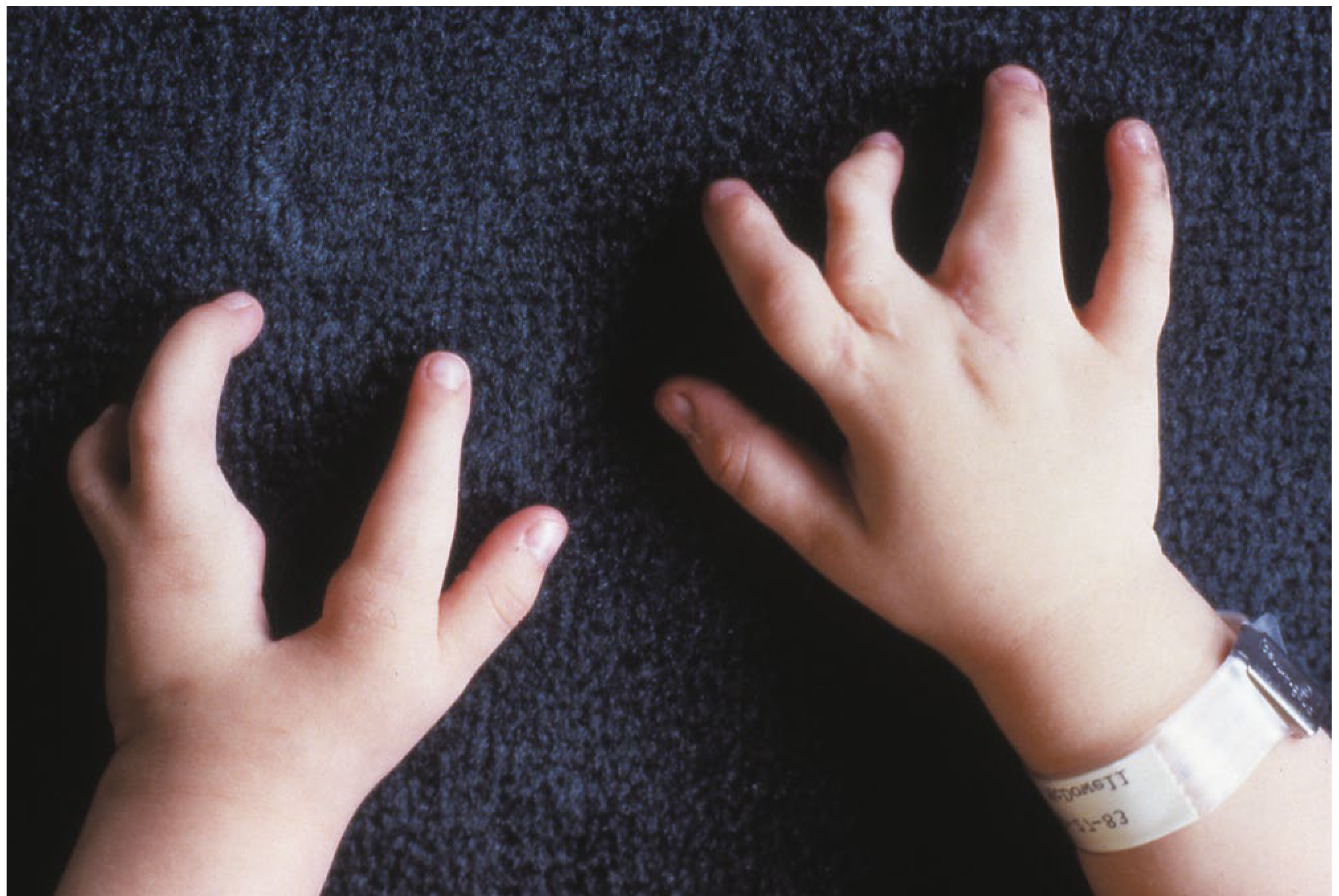 Typical bilateral cleft hand deformity showing V-shaped central cleft - both hands of a child