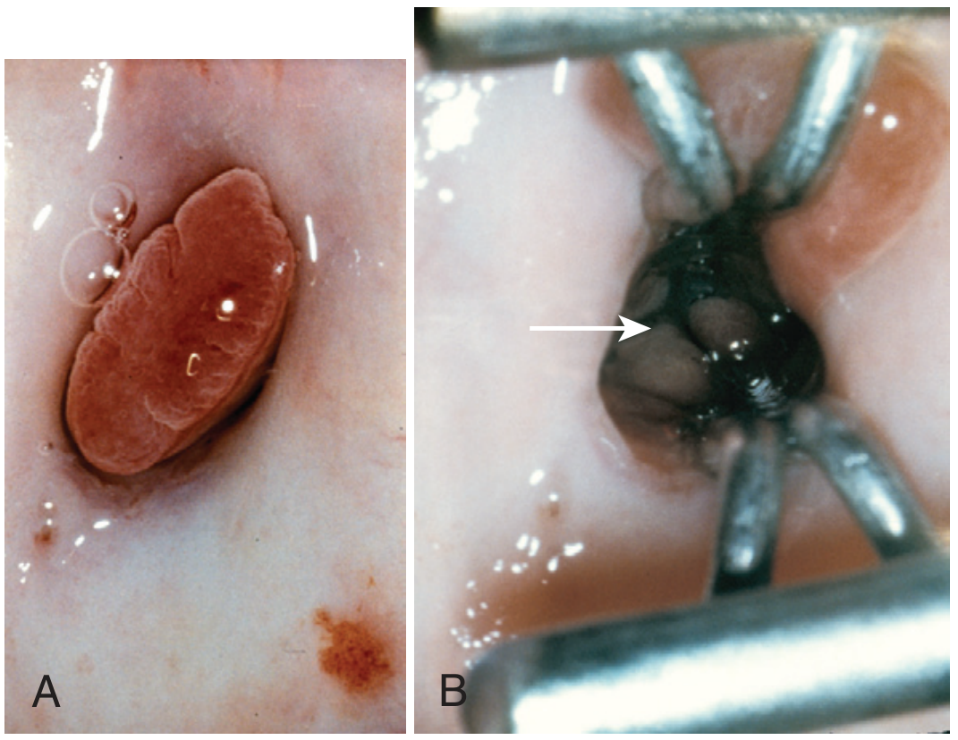 Endocervical polyp (A) and polyp base identified with endocervical speculum (B, arrow)