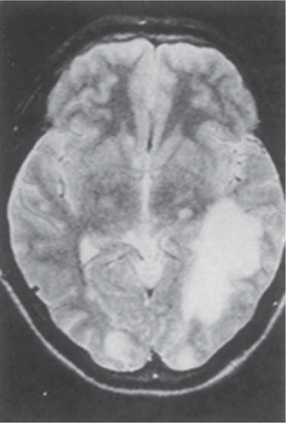 Balamuthia brain MRI