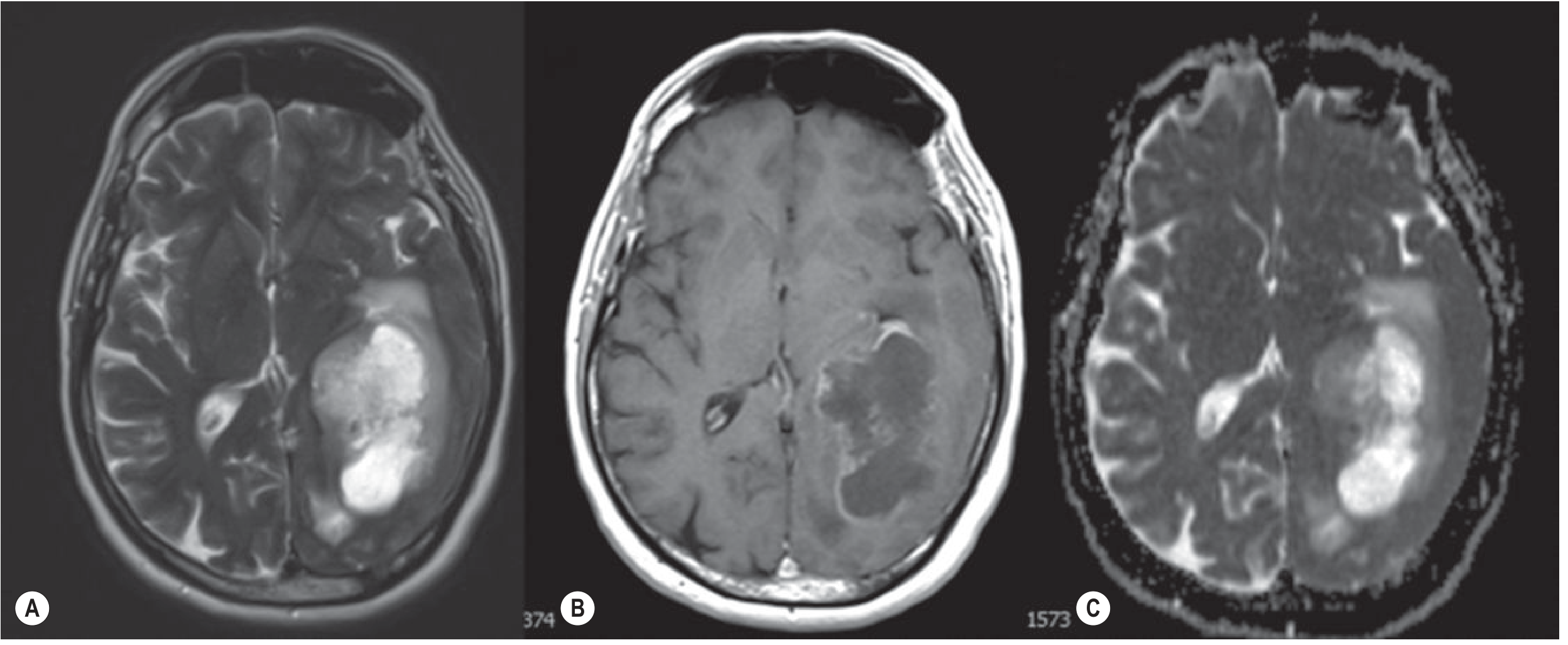 GBM MRI: T2 heterogeneous mass with surrounding edema, post-Gd ring enhancement, ADC restricted diffusion - Grainger & Allison's Radiology