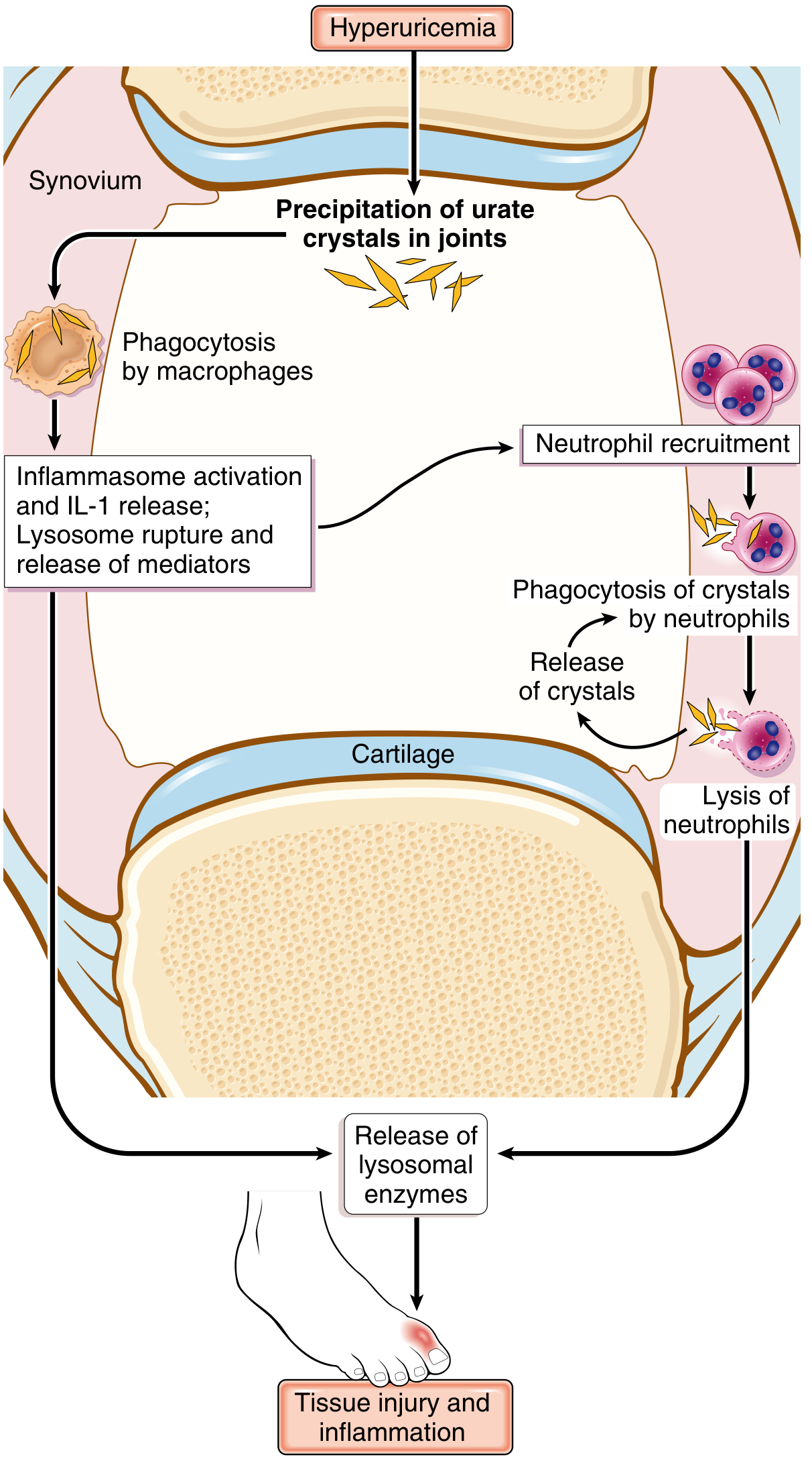 Pathogenesis of acute gouty arthritis - urate crystals are phagocytosed by macrophages, activating the inflammasome and IL-1 release, leading to neutrophil recruitment, tissue injury and inflammation