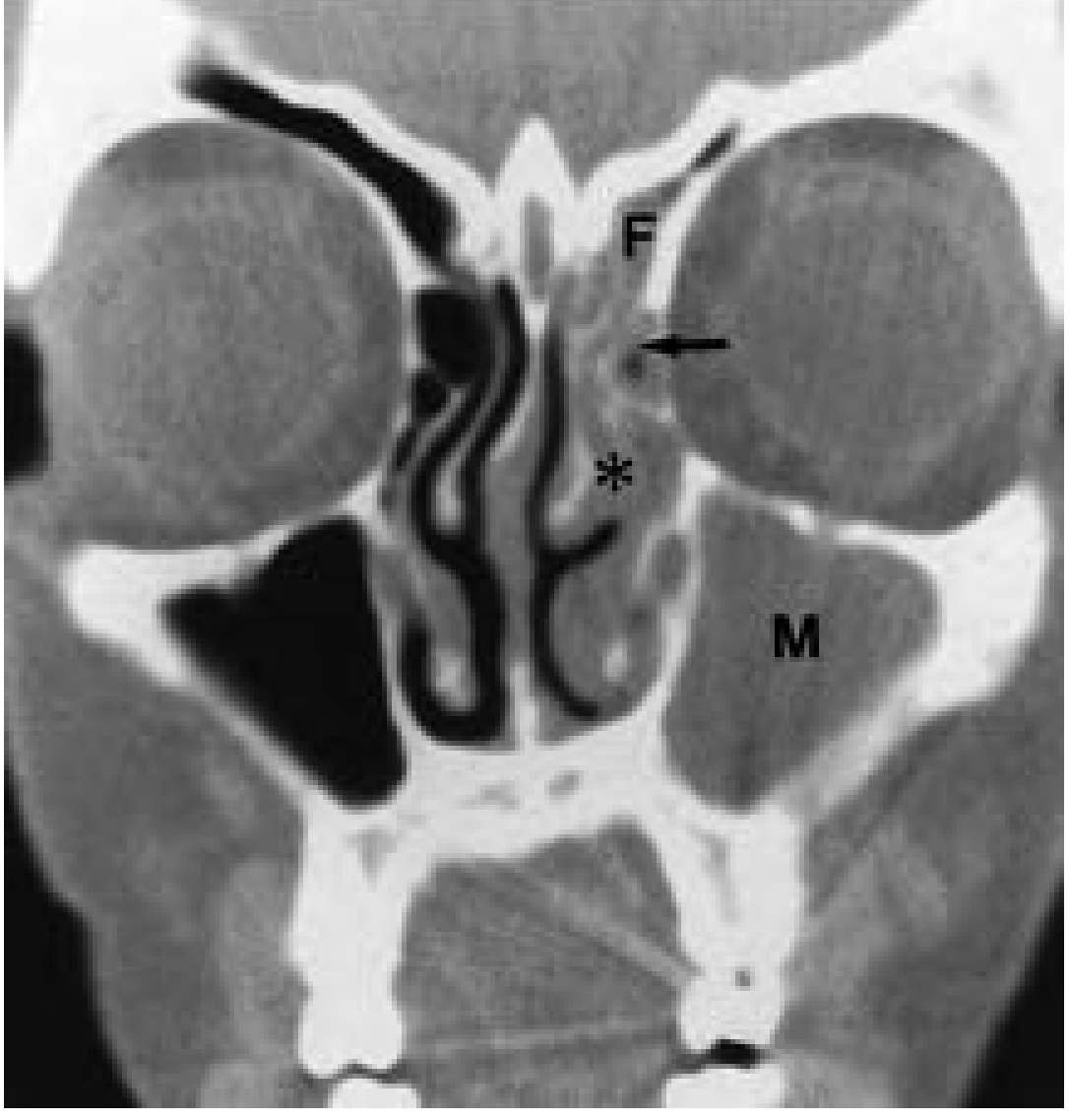 OMU pattern sinusitis coronal CT