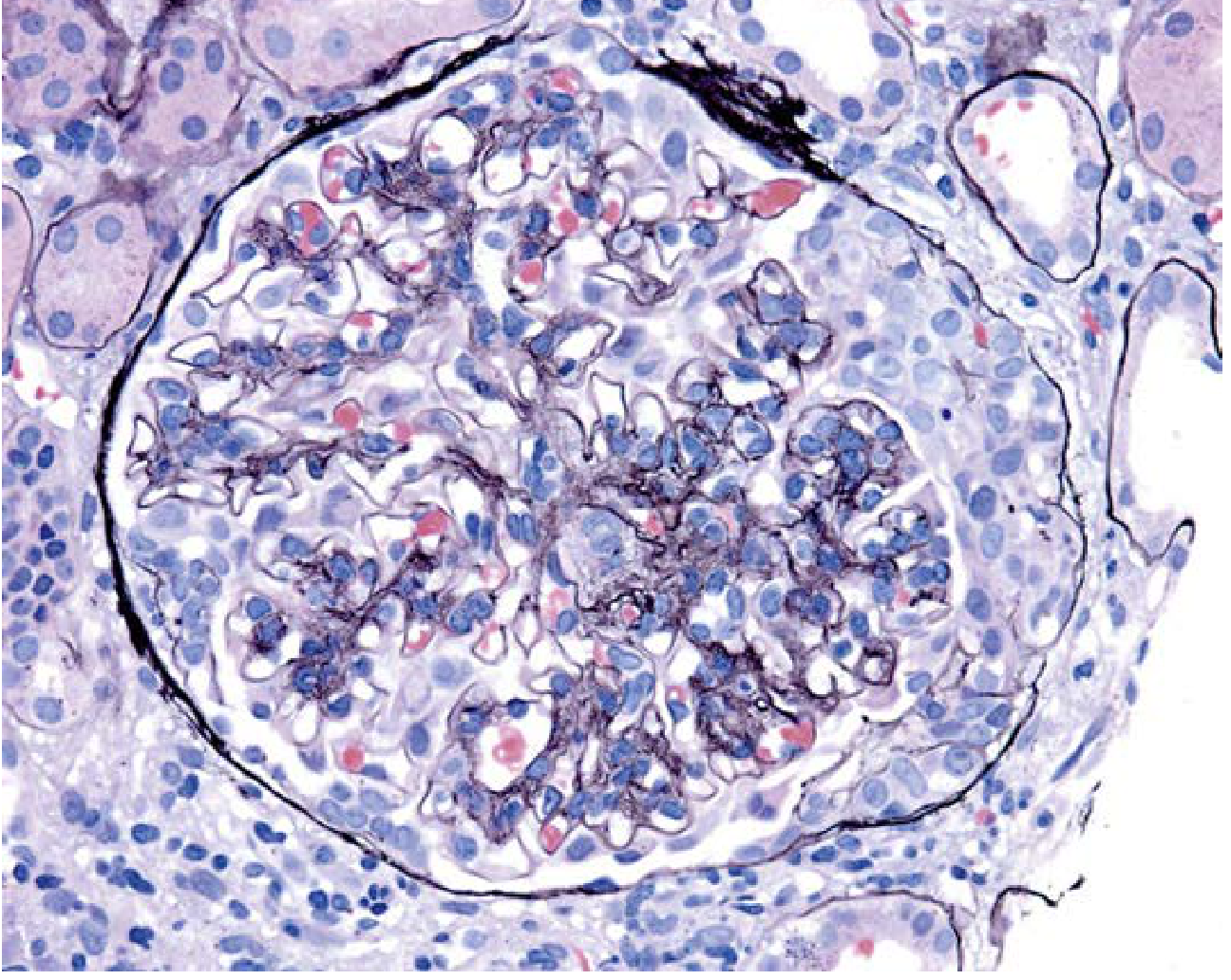 IgA nephropathy with crescent formation - Jones silver stain showing cellular crescent in Bowman space