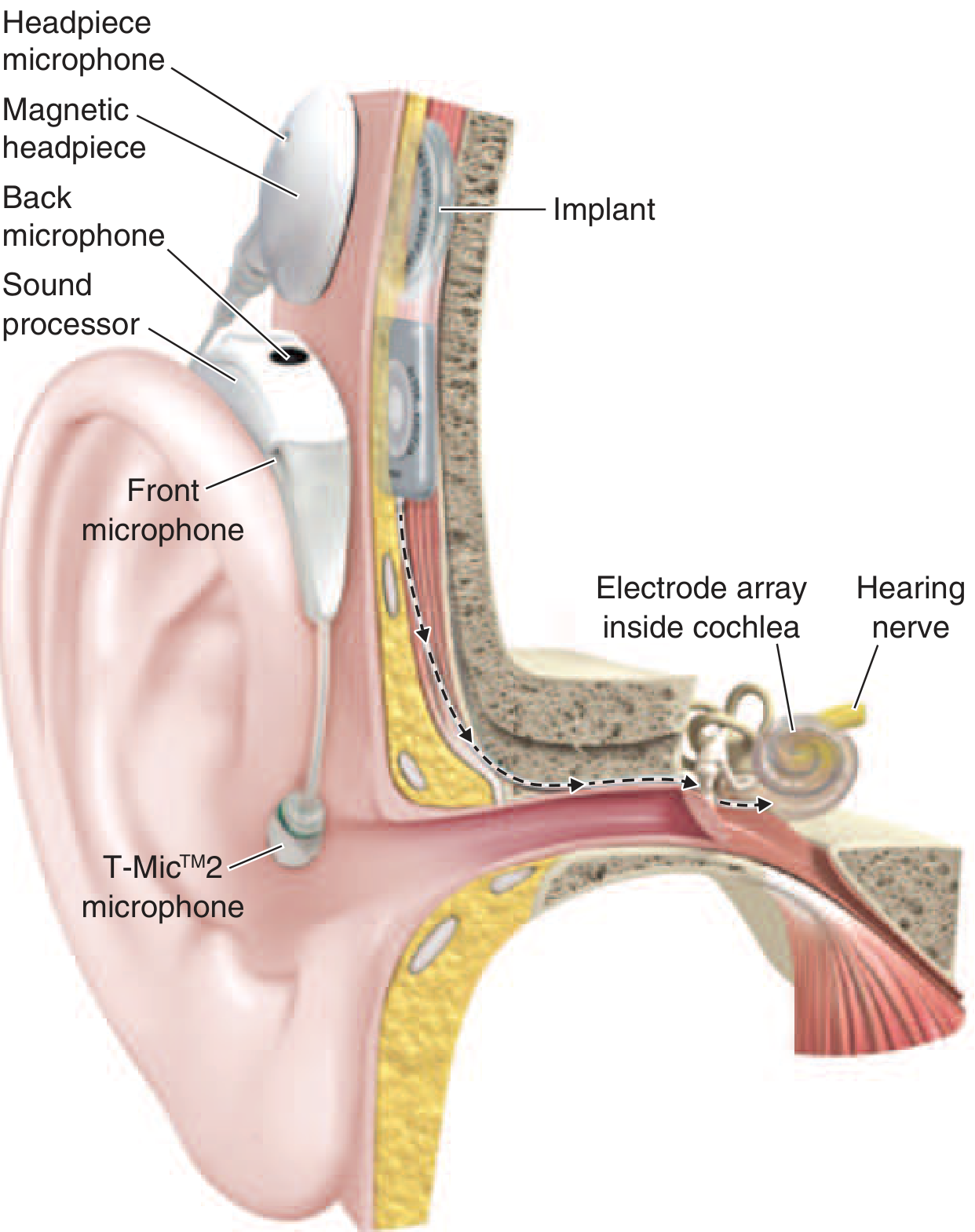 Cochlear implant diagram showing electrode array inside cochlea and external processor