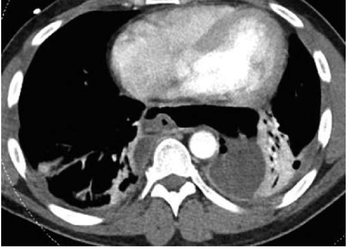 CT image of delayed post-emetic oesophageal rupture with air around lower oesophagus and bilateral loculated effusions