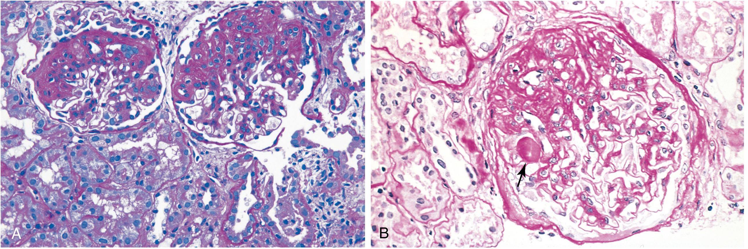 Focal segmental glomerulosclerosis - PAS stain showing segmental sclerosis (A) and hyaline insudation with lipid vacuoles (B)