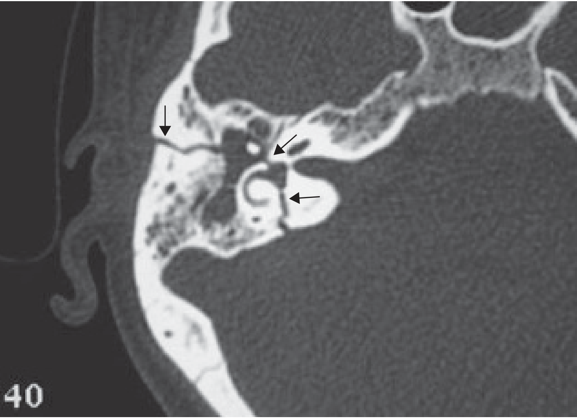 Transverse temporal bone fracture CT: fracture passes through the vestibule and tympanic segment of the facial nerve (arrows), with otic capsule involvement