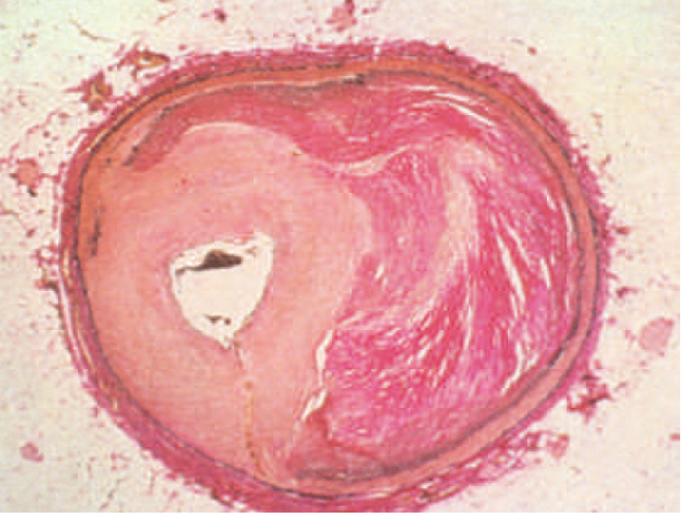 Histology showing severe neointimal hyperplasia and in-stent restenosis - the vessel lumen is dramatically narrowed by fibrocellular tissue
