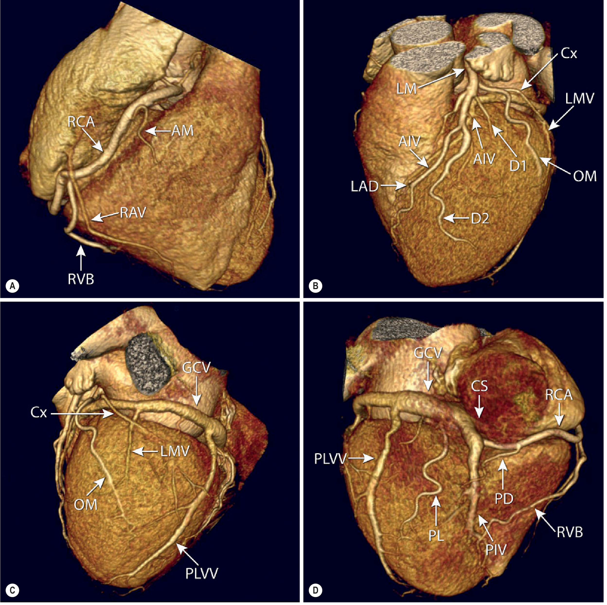 4-panel CT volume rendering showing all coronary artery branches: RCA with acute marginal (AM), LAD with diagonals (D1,D2), circumflex (Cx) with obtuse marginals (OM), and posterior branches (PD, PL)