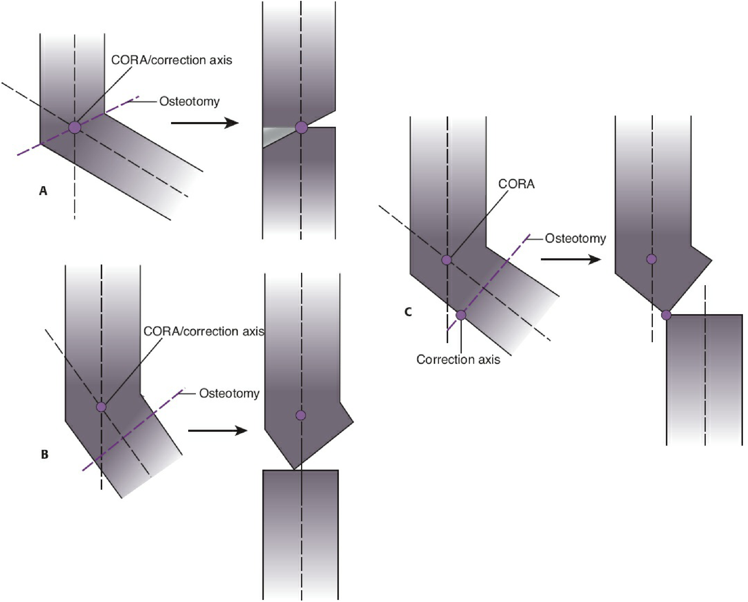Possible results when using osteotomy - A: CORA = correction axis = osteotomy (pure angular correction); B: CORA = correction axis but osteotomy proximal/distal (angular + translation); C: CORA ≠ correction axis (iatrogenic translational deformity)