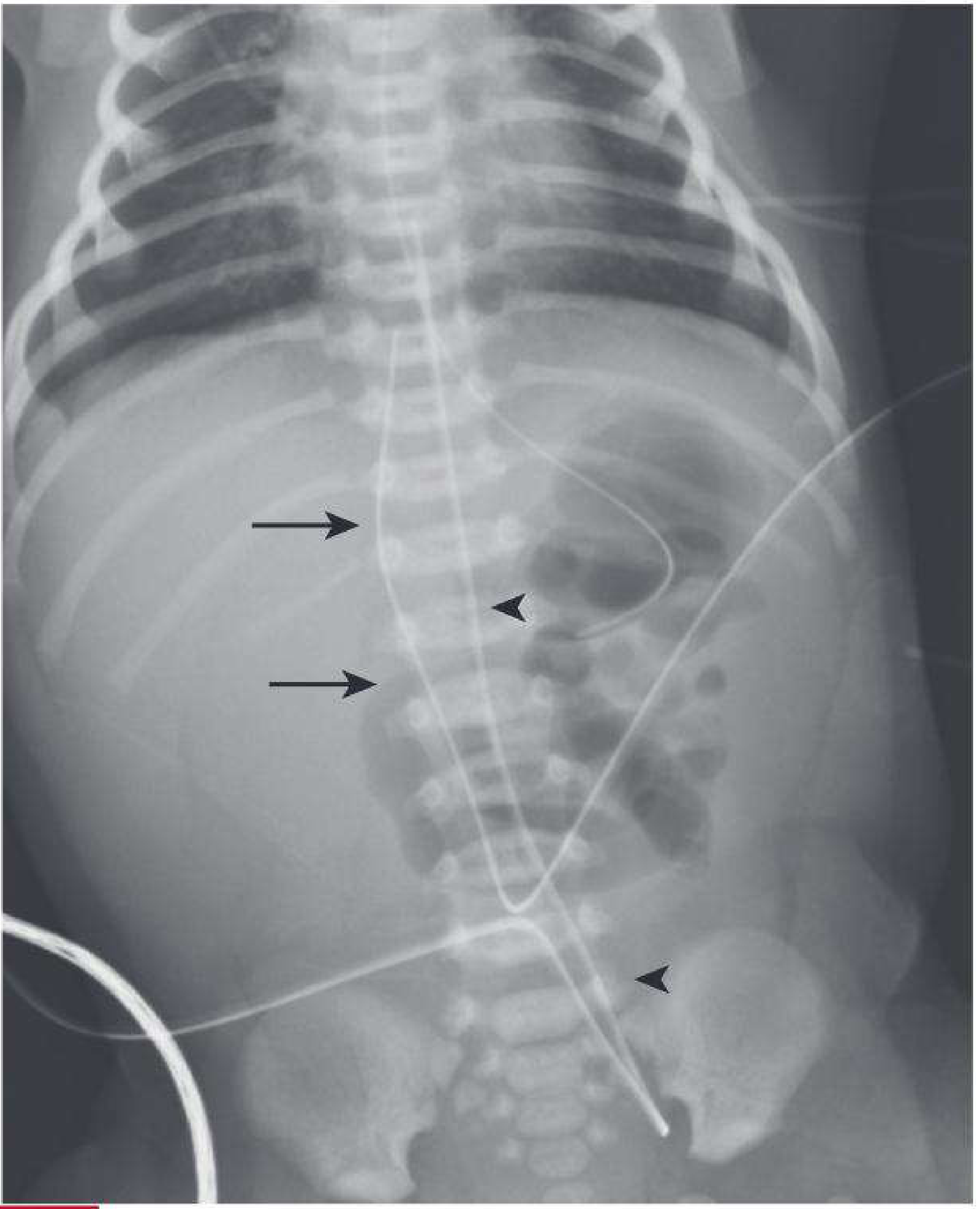 UAC and UVC on abdominal X-ray - UAC dips into pelvis before ascending aorta, UVC goes straight up