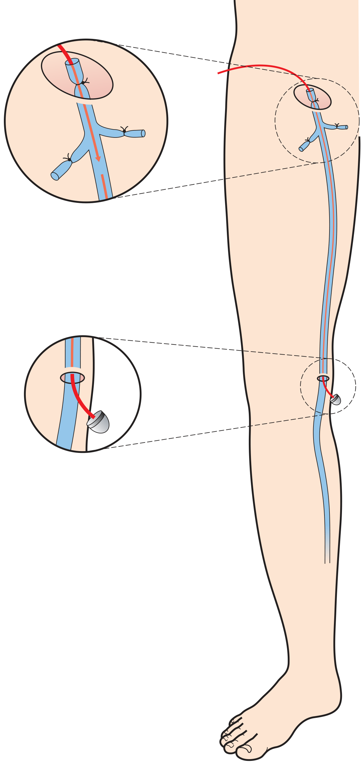 The full procedure - flush junction ligation at the top and the stripper instrument being passed down the GSV