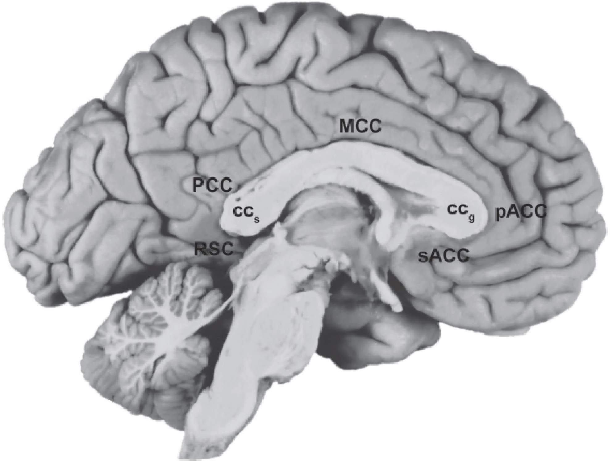 Photograph of the medial aspect of the left hemisphere showing subdivisions of the cingulate gyrus - sACC, pACC, MCC, PCC, RSC