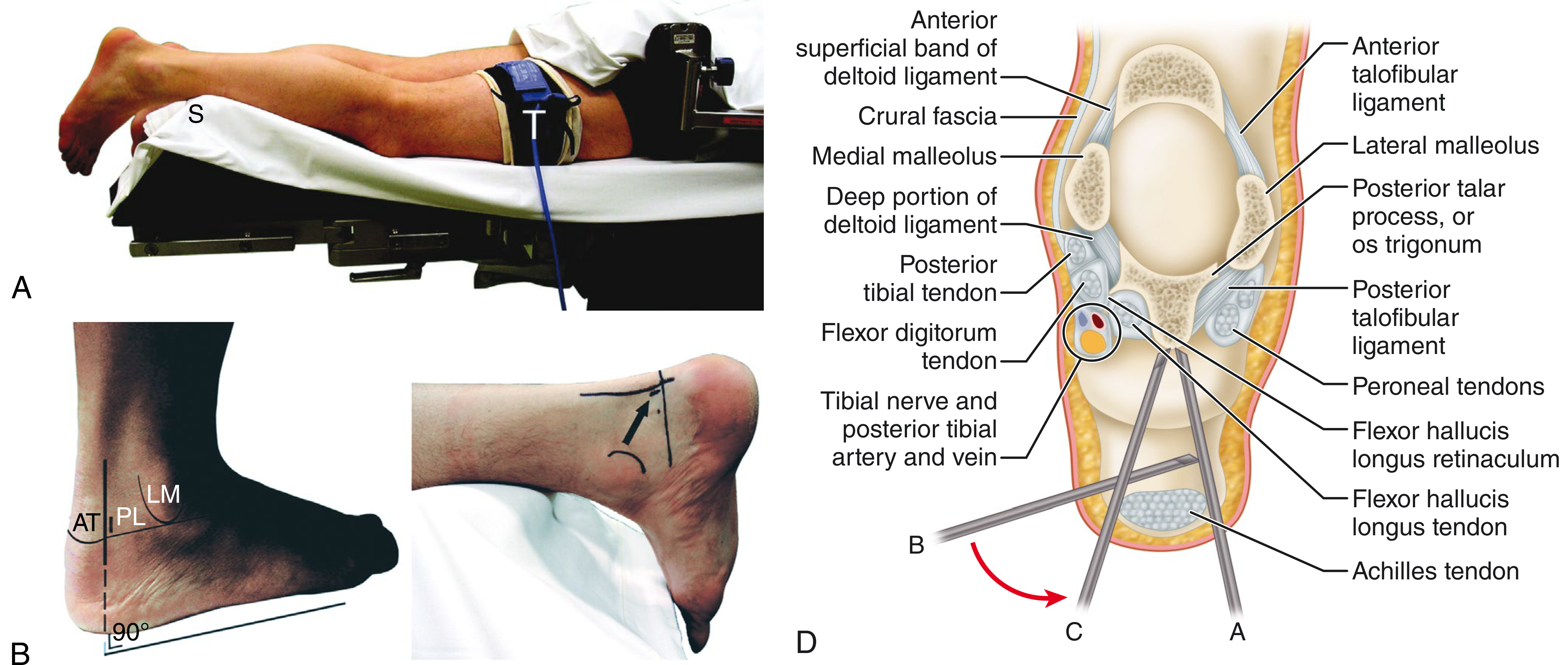 Cross-sectional view of posterior ankle arthroscopy showing FHL as the landmark separating the posterolateral working space from the medial neurovascular bundle, with posterolateral and posteromedial portal trajectories