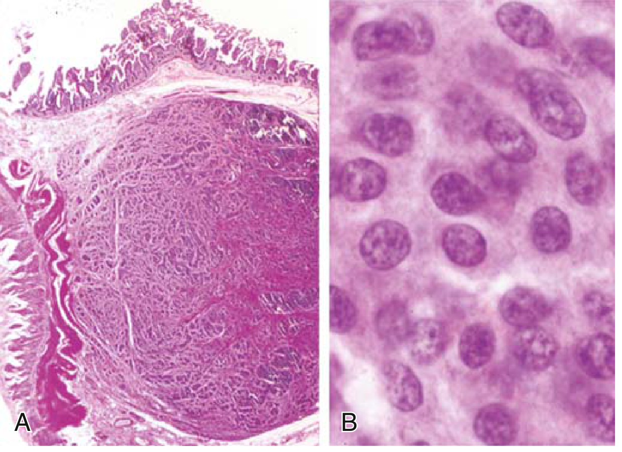 GI Carcinoid (NET) - submucosal nodule (A) and salt-and-pepper nuclear pattern (B)