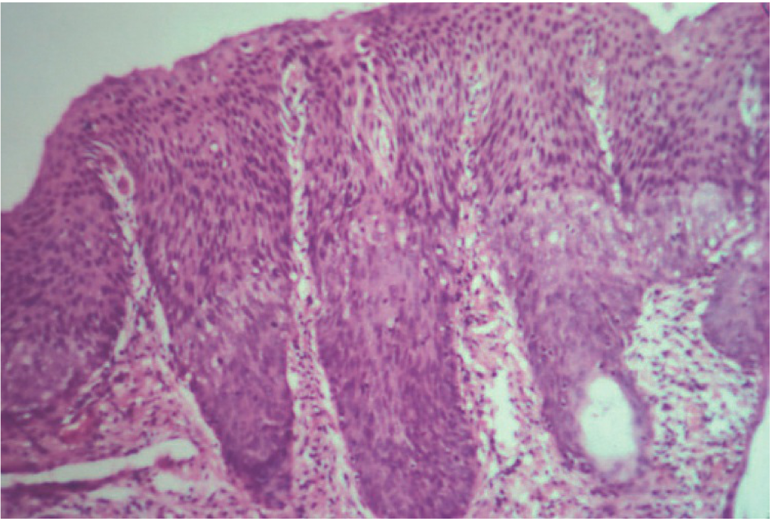 CIN 3 colposcopic appearance - Berek & Novak Fig 16-13