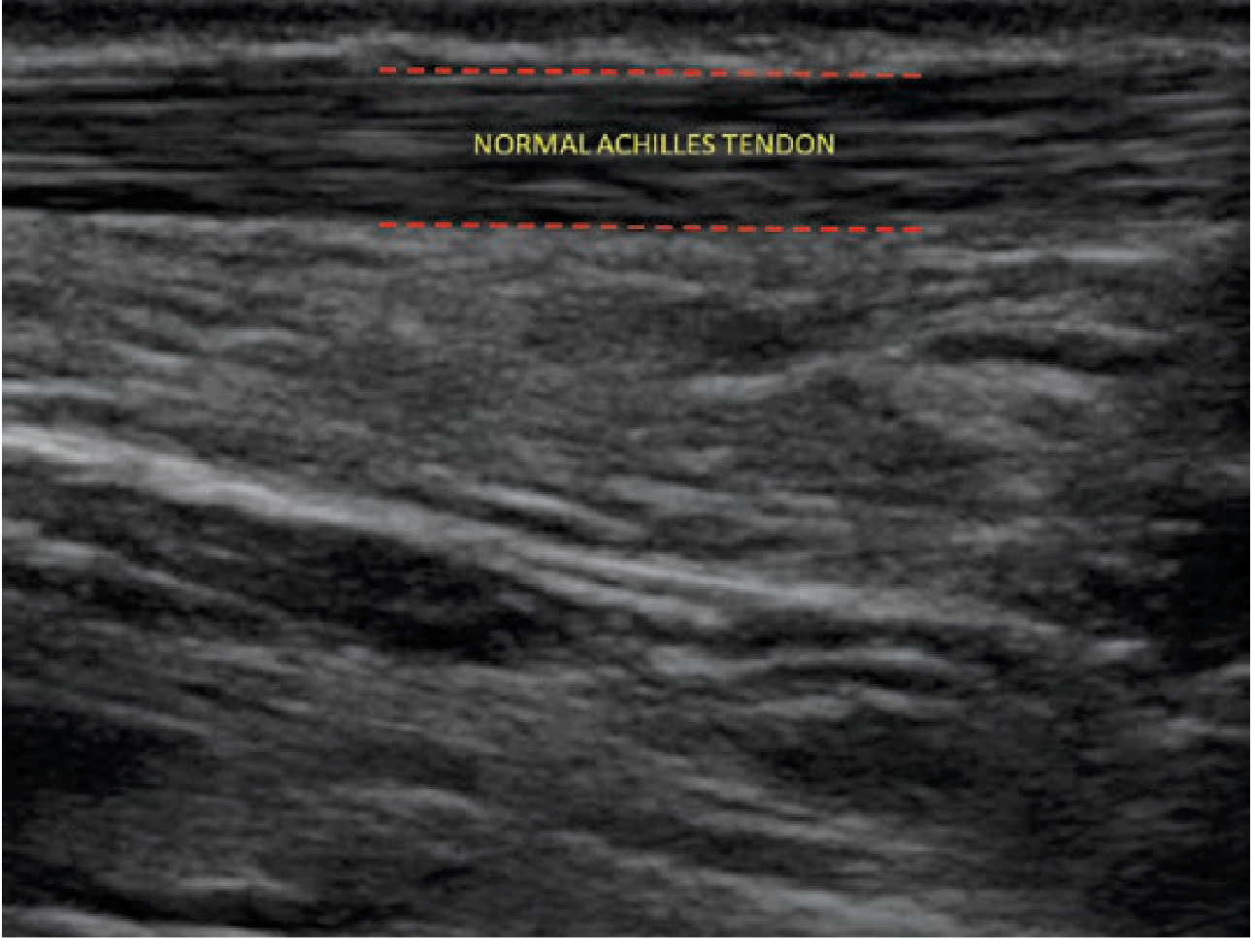 Normal Achilles Tendon - longitudinal ultrasound showing intact parallel fibrillar echotexture between red dashed lines