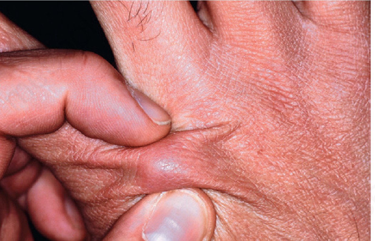 Centipede bite on the wrist showing erythematous swelling
