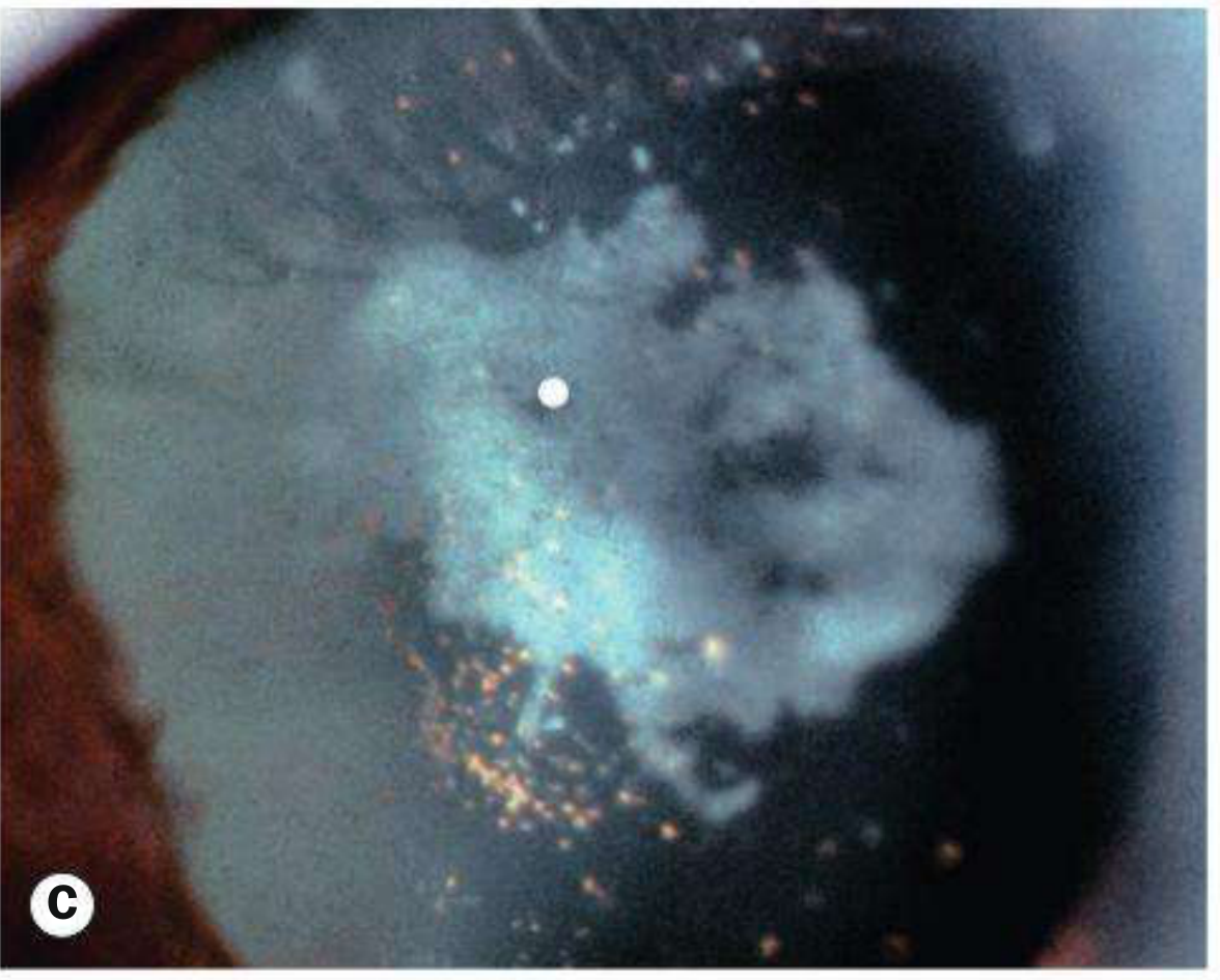 Glaukomflecken - grey-white anterior subcapsular opacities within the pupillary area, as seen on slit-lamp