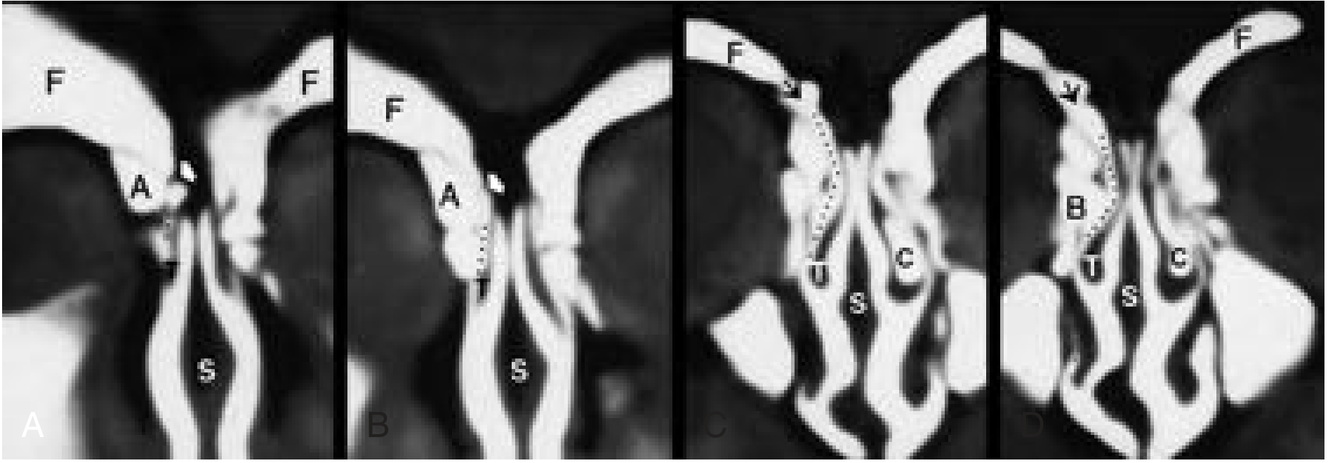 Frontal sinus anatomy on coronal CT: agger nasi cell (A), frontal sinus (F), nasal septum (S), ethmoid bulla (B), middle turbinate (T), concha bullosa (C) shown from anterior to posterior