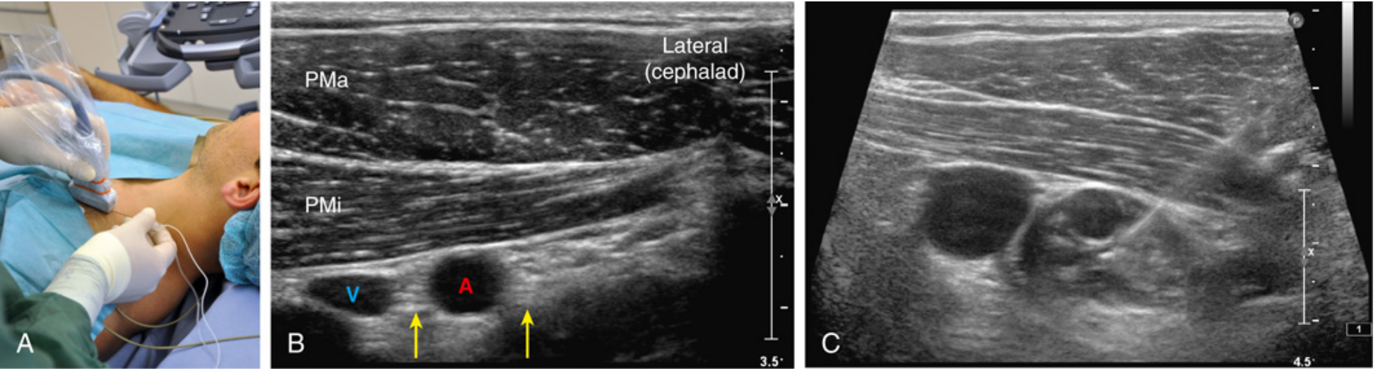 USG image (panel B) showing PMa = pectoralis major, PMi = pectoralis minor, A = axillary artery (red), V = axillary vein (blue), yellow arrows = brachial plexus cords; Panel A = patient positioning with arm abducted, Panel C = LA injection spread posterior to artery
