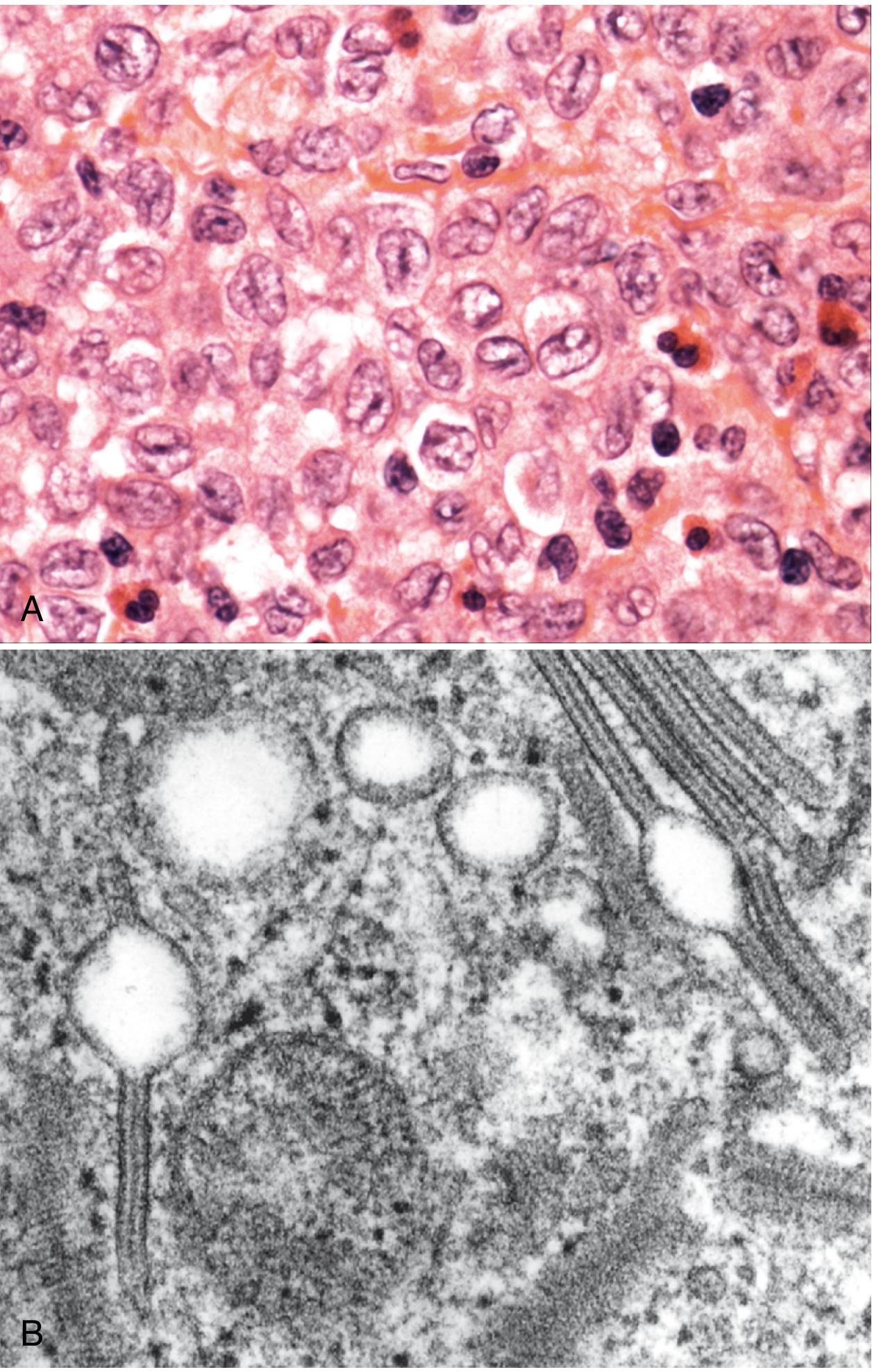 LCH - Langerhans cells (A: H&E with grooved nuclei) and Birbeck granules on EM (B: tennis racket-shaped)