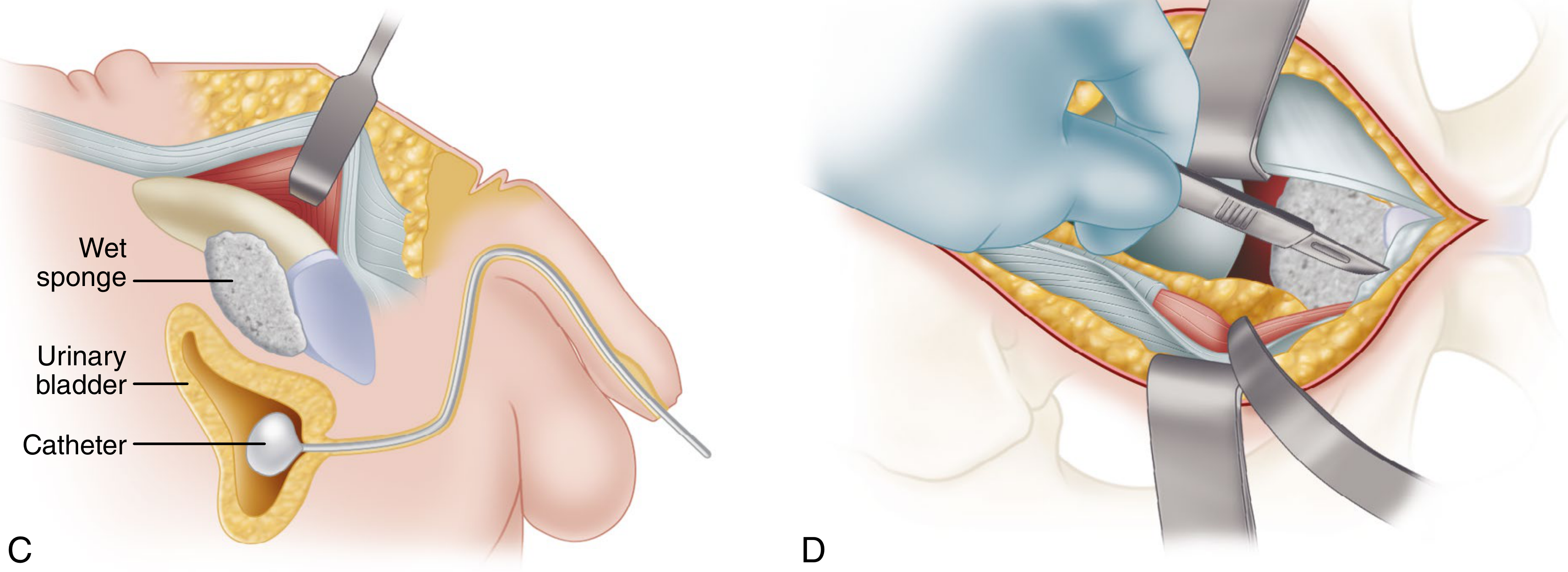 Bladder protection with wet sponge and catheter visible; periosteal dissection of superior pubic bone