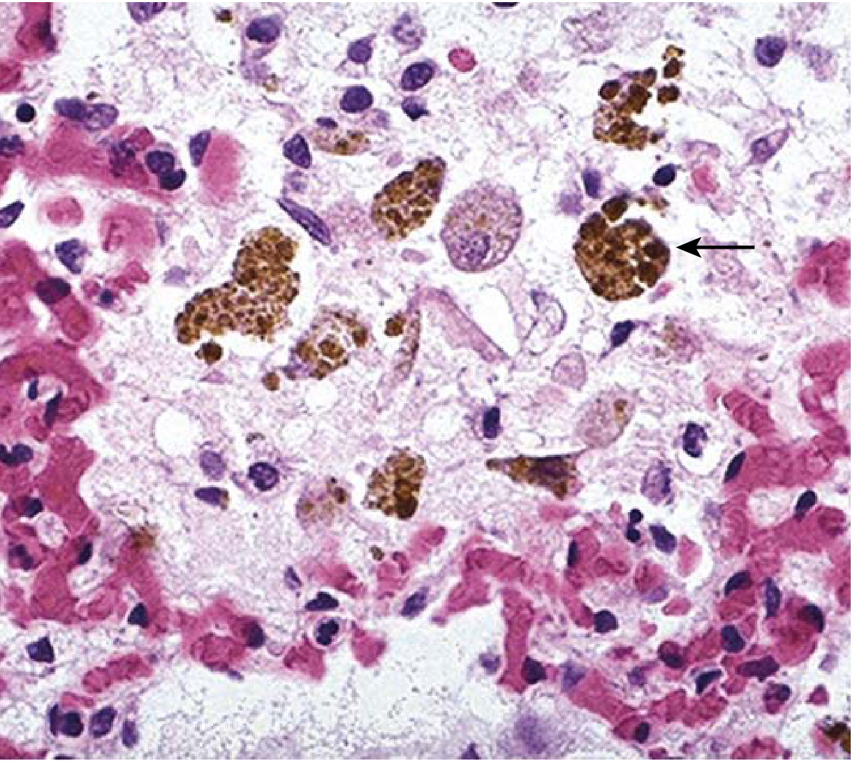 CVC Lung - Heart Failure Cells (H&E)