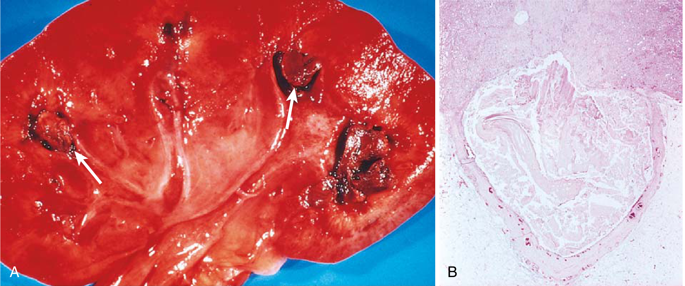 Acute pyelonephritis - papillary necrosis (gross hemorrhagic necrosis of papillae, left) and histology showing tubular pus (right)