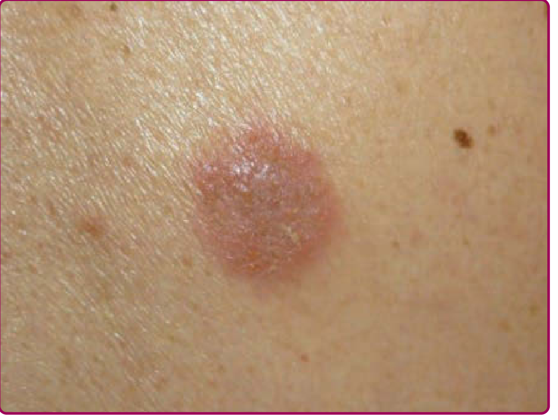 Nummular eczema - single coin-shaped plaque with pinpoint erosions and crusting