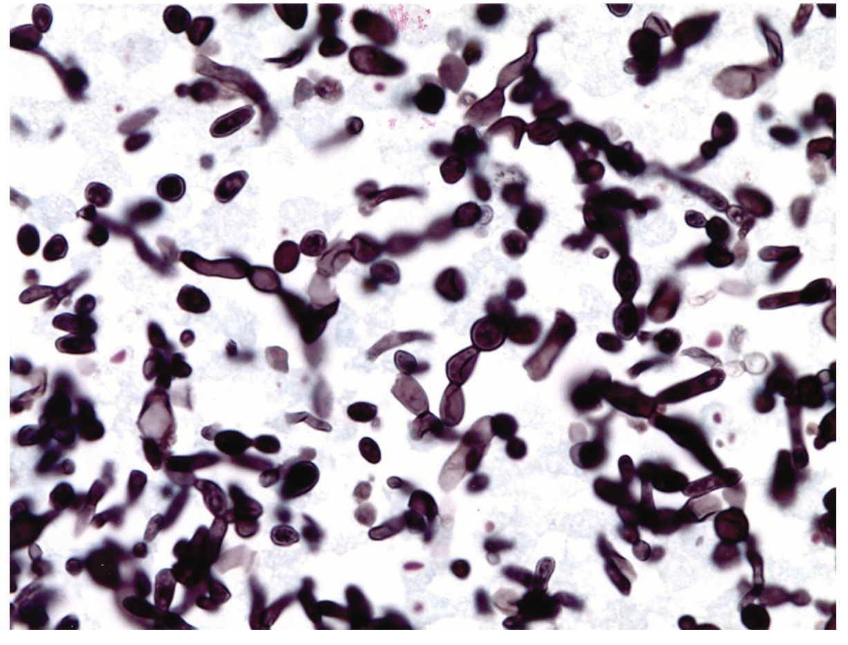 GMS stain showing Candida budding yeasts and pseudohyphae (x1000)