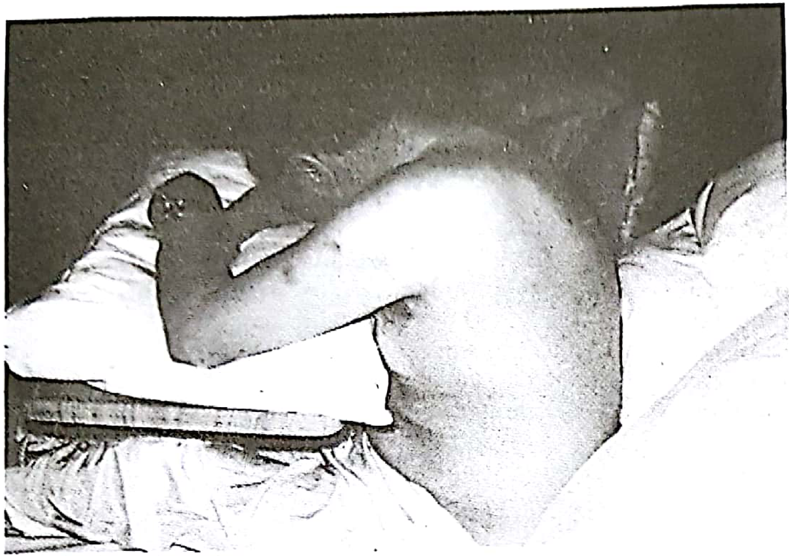 Patient positioned leaning forward on bed table - ideal position for chest aspiration (Pye's Surgical Handicraft)