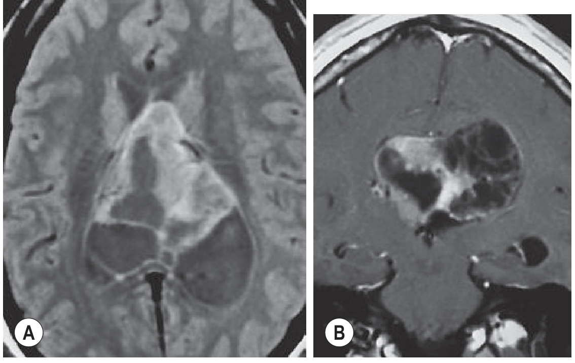 Central Neurocytoma MRI - Axial PD and Coronal T1 post-contrast