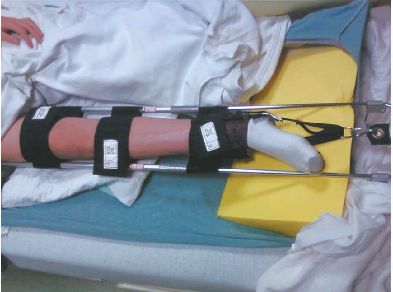 Hare traction splint applied for femoral shaft fracture stabilization in the field