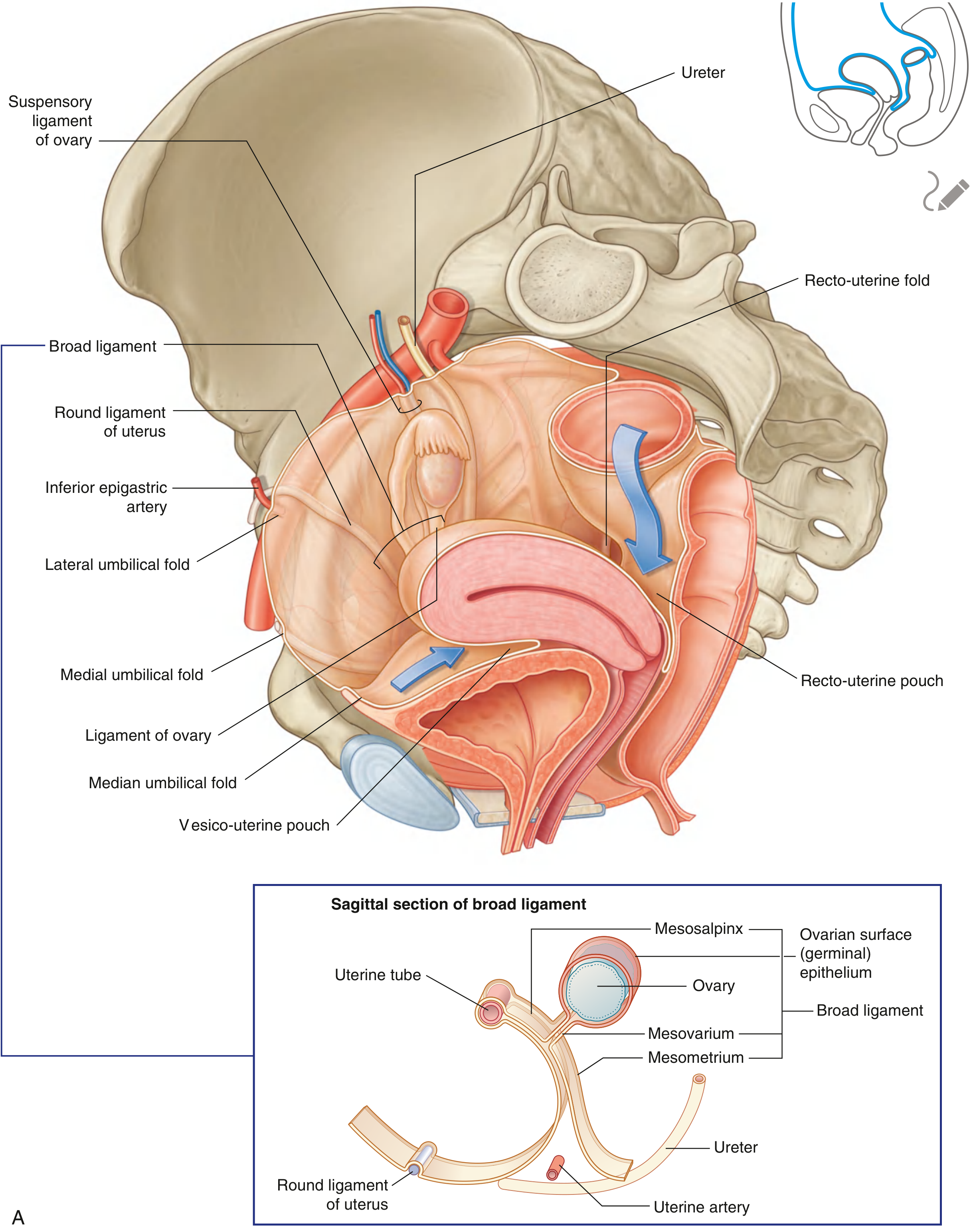 Peritoneum and ligaments of the female pelvis, showing broad ligament, round ligament of uterus, ligament of ovary, suspensory ligament of ovary, recto-uterine fold and pouch, with a sagittal section inset showing mesosalpinx, mesovarium, mesometrium, round ligament, and uterine artery