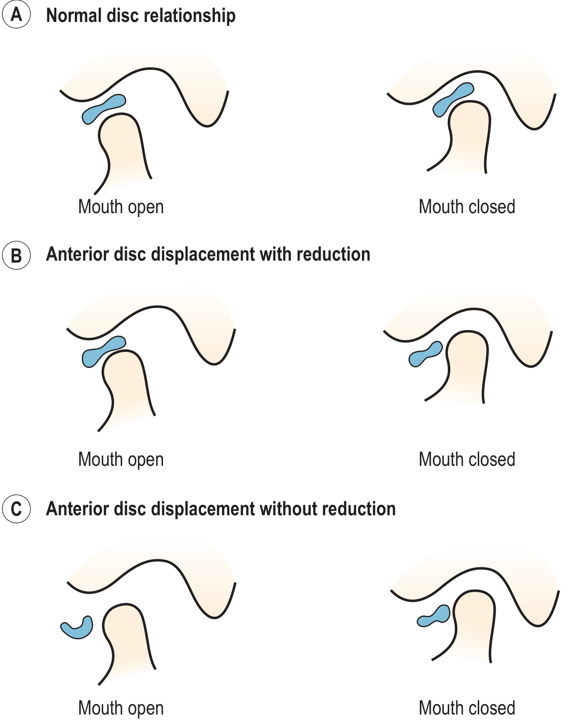 Diagrammatic representation of disc displacement (A=normal, B=with reduction, C=without reduction)