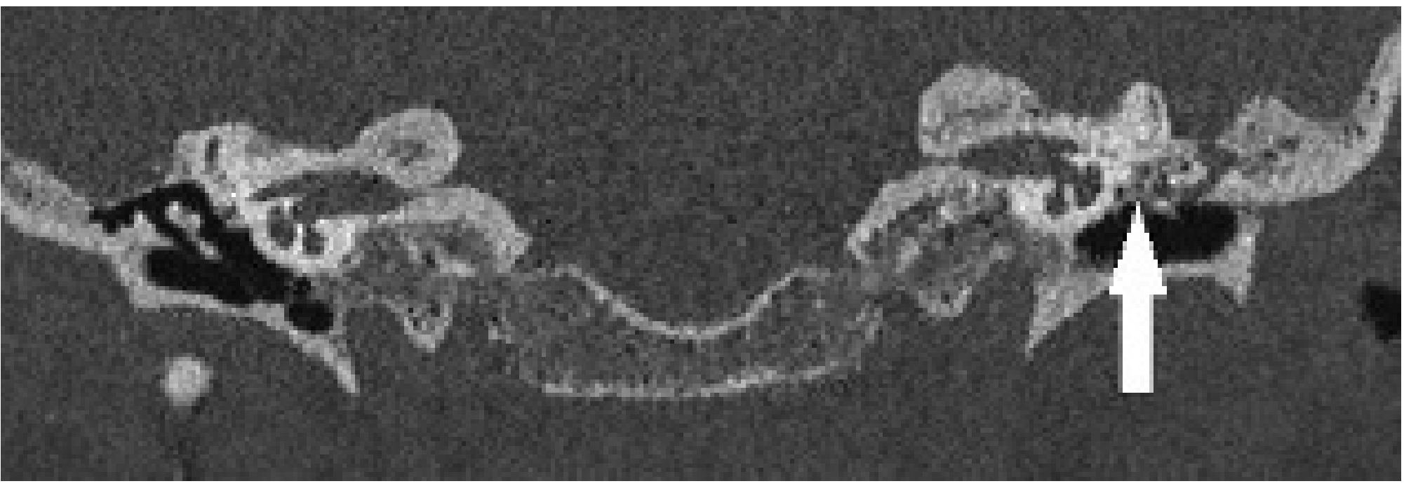 Coronal CT - Tympanosclerosis