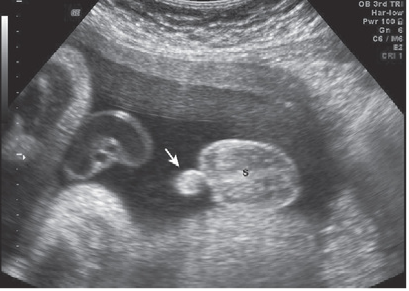 33-week male fetus USG - penis (arrow) and scrotum (S) visible