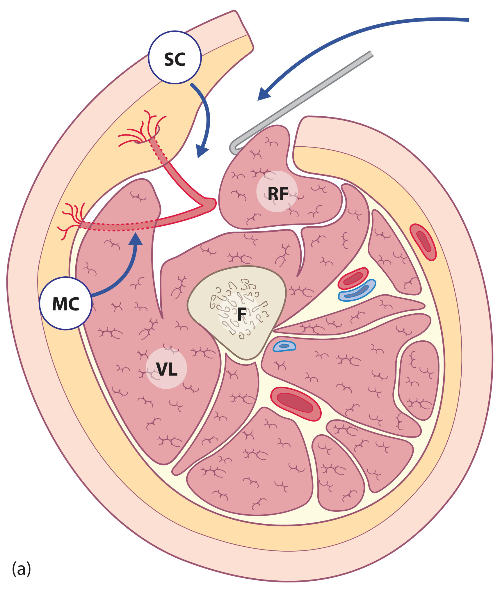 ALT flap cross-sectional anatomy - SC (septocutaneous) and MC (musculocutaneous) perforator types relative to rectus femoris (RF), vastus lateralis (VL) and femur (F)