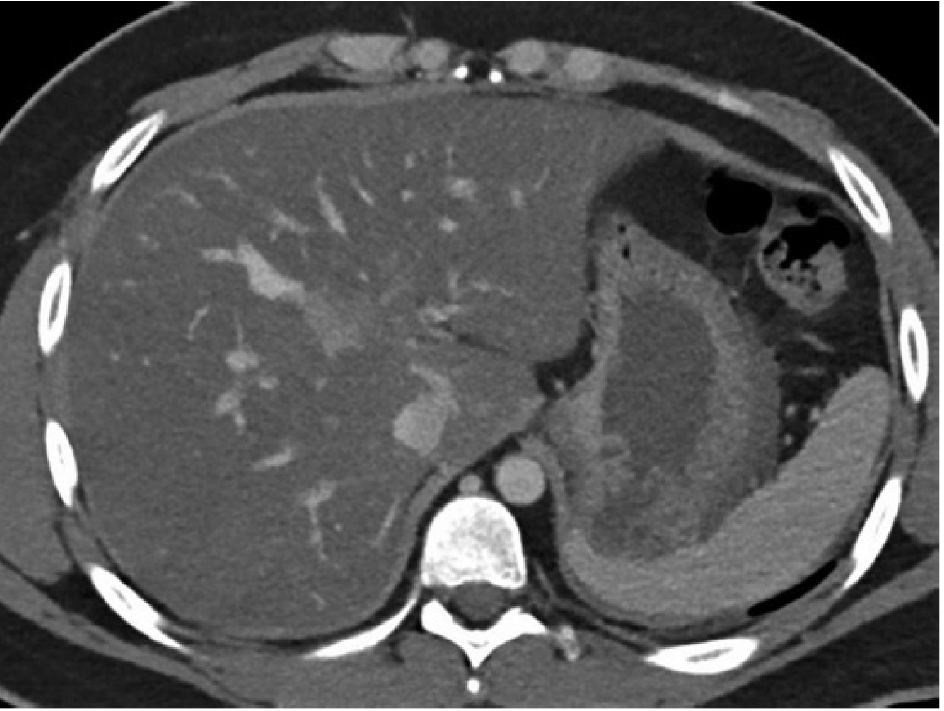 Venous-phase contrast-enhanced CT demonstrating a hypodense (fatty) liver - liver appears darker than the spleen, indicating lipid infiltration — Mulholland & Greenfield's Surgery, 7e