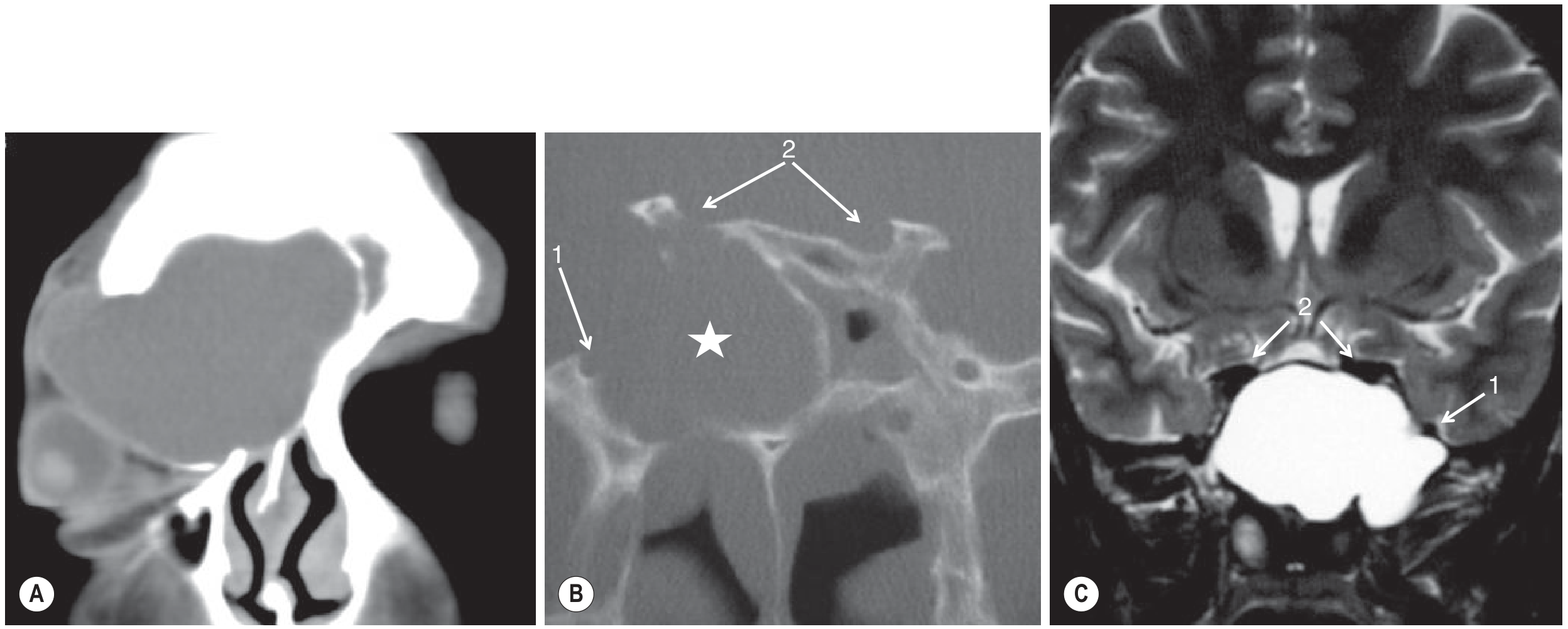 Mucocele frontal and sphenoid CT and MRI