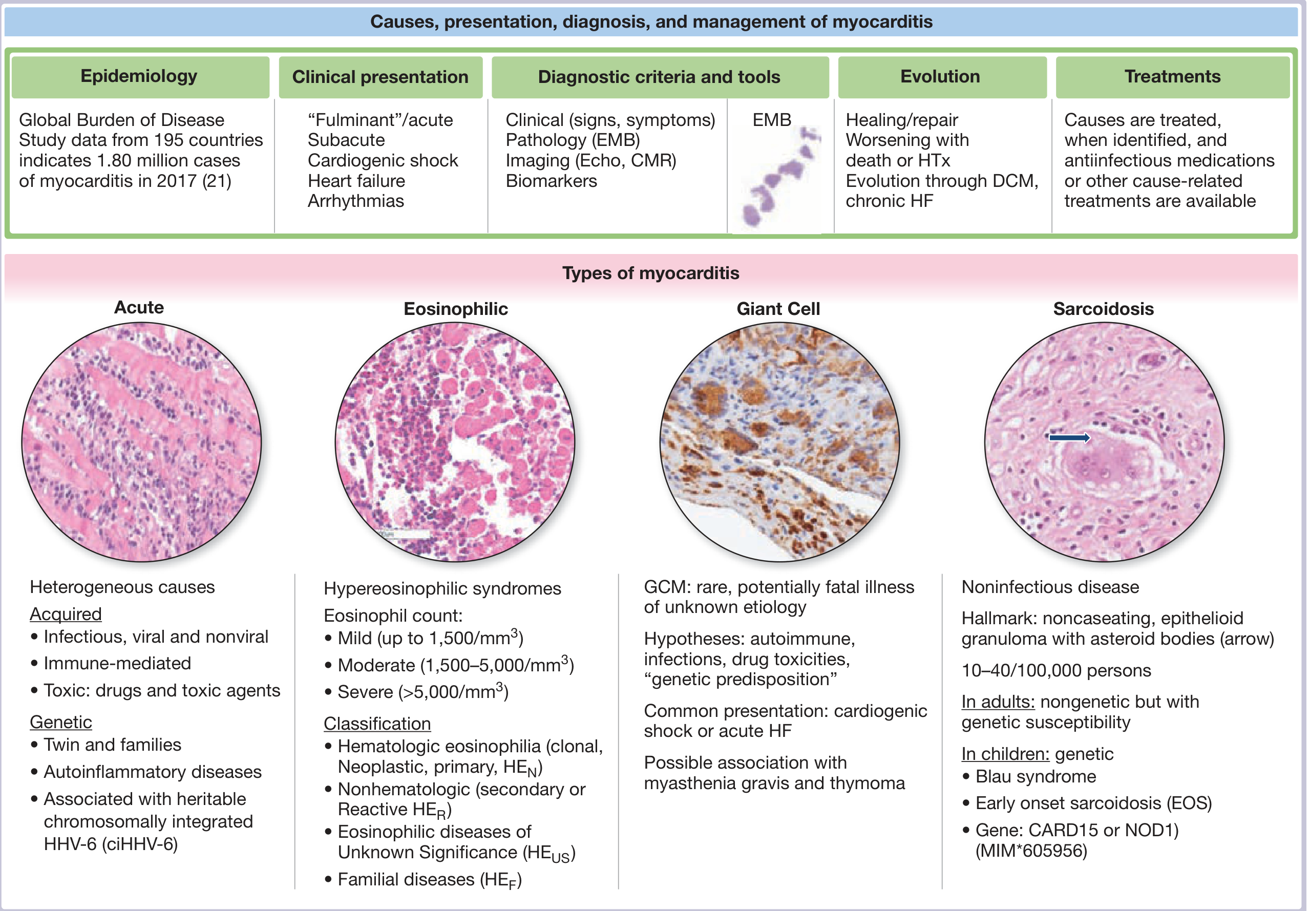 Myocarditis overview: causes, presentation, diagnostic criteria, and types