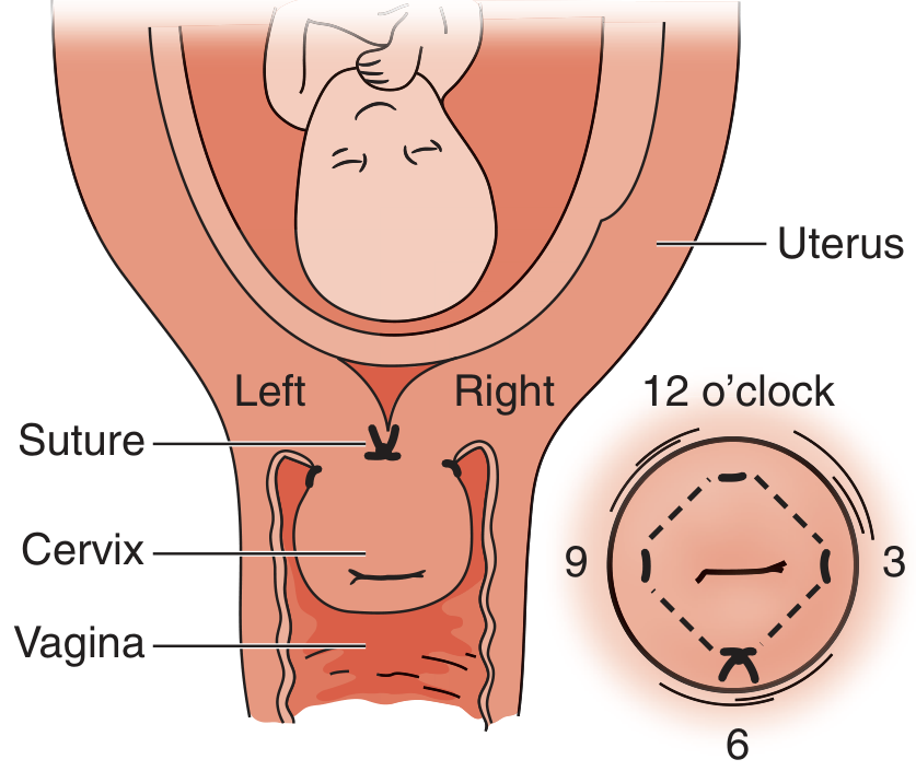 Cervical cerclage anatomy and suture placement showing the pursestring pattern at 6, 3, 12, and 9 o'clock positions