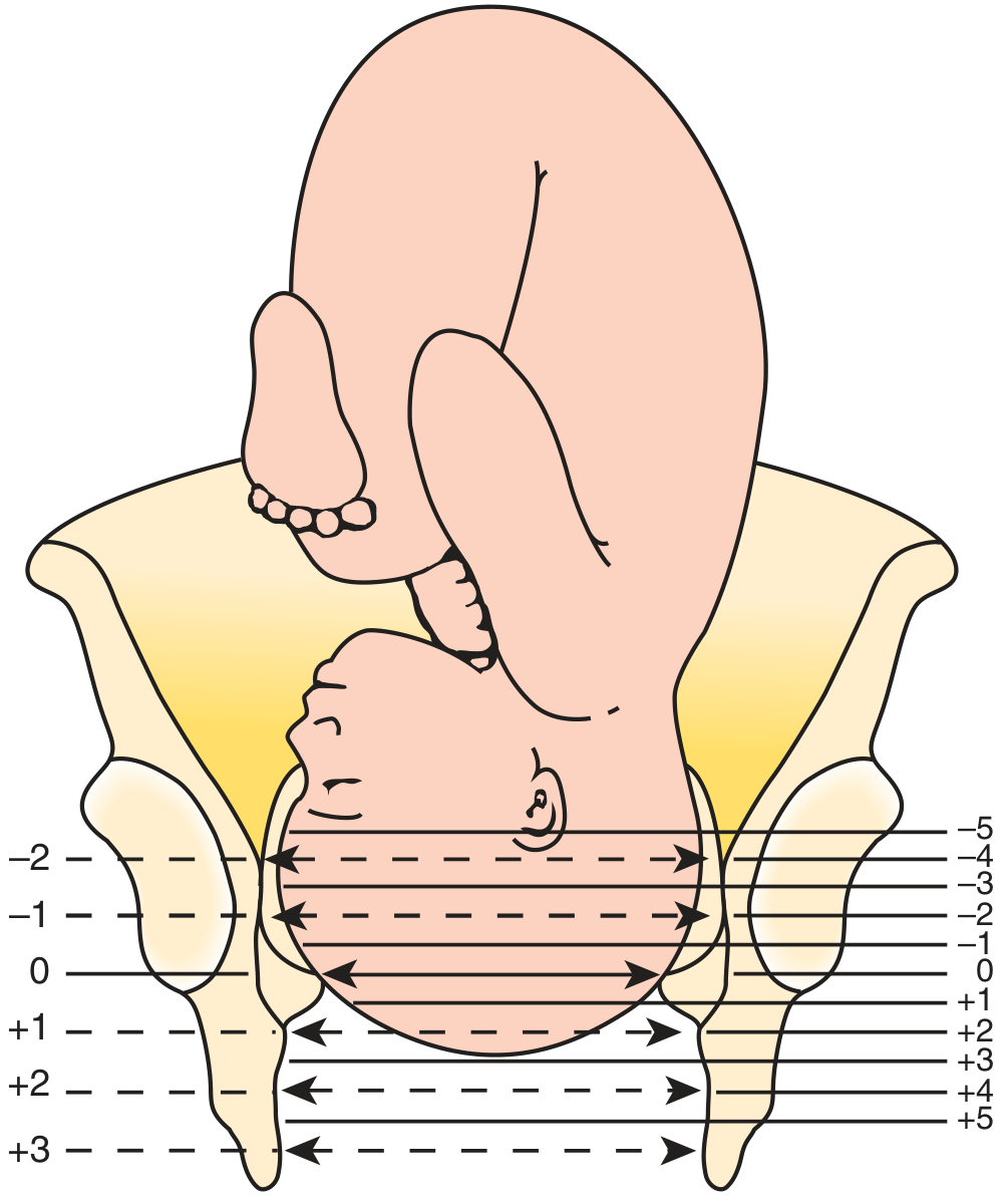 Fetal stations diagram showing the old 3-point and new 5-point classification relative to ischial spines