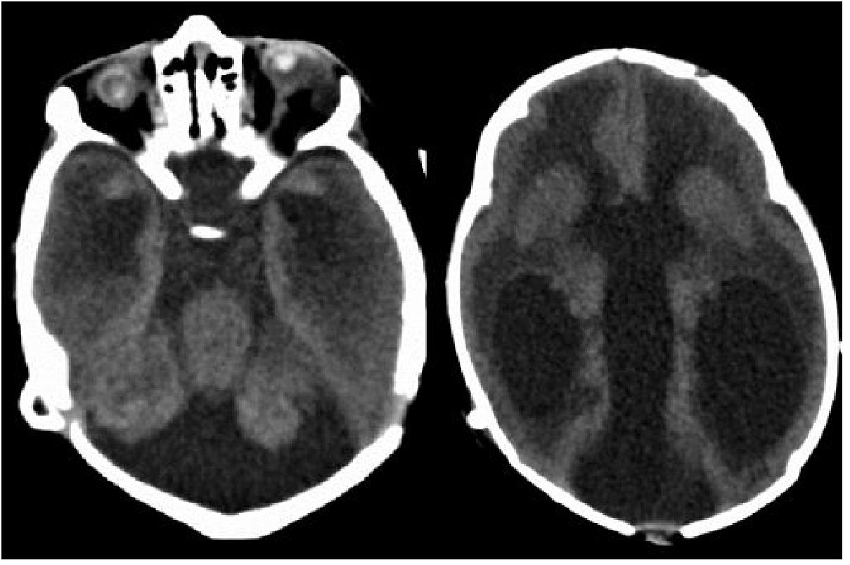 CT scan of neonate with congenital TORCH infection showing bilateral calcified globes (phthisis bulbi), Dandy-Walker malformation, and hydrocephalus