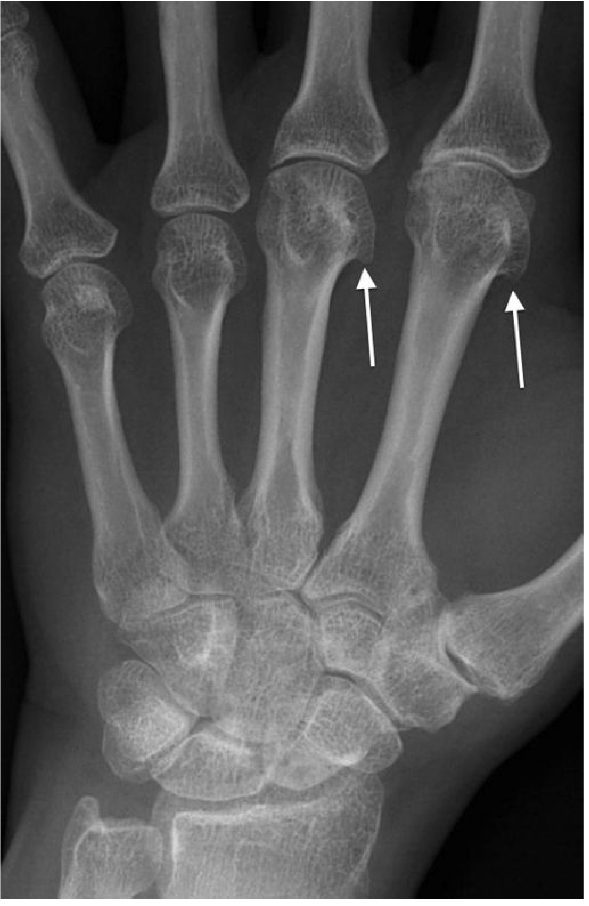X-ray of hand showing hook osteophytes on radial aspects of index and middle finger metacarpal heads (arrows) - classical haemochromatosis arthropathy with chondrocalcinosis of the wrist
