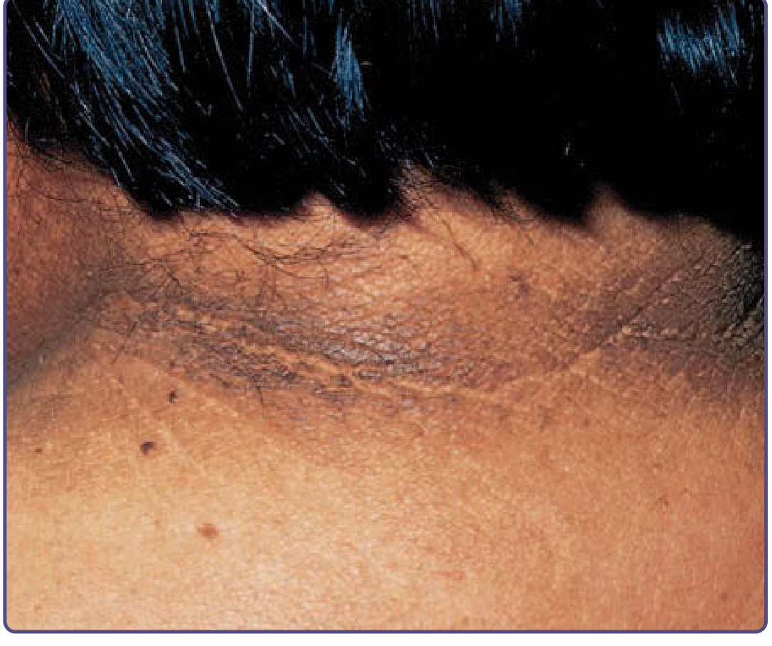 Acanthosis nigricans on the neck - from Fitzpatrick's Dermatology